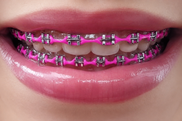 Hot Pink Braces: The Complete Guide to Shades, Skin Tone Matches, and Combos That Pop