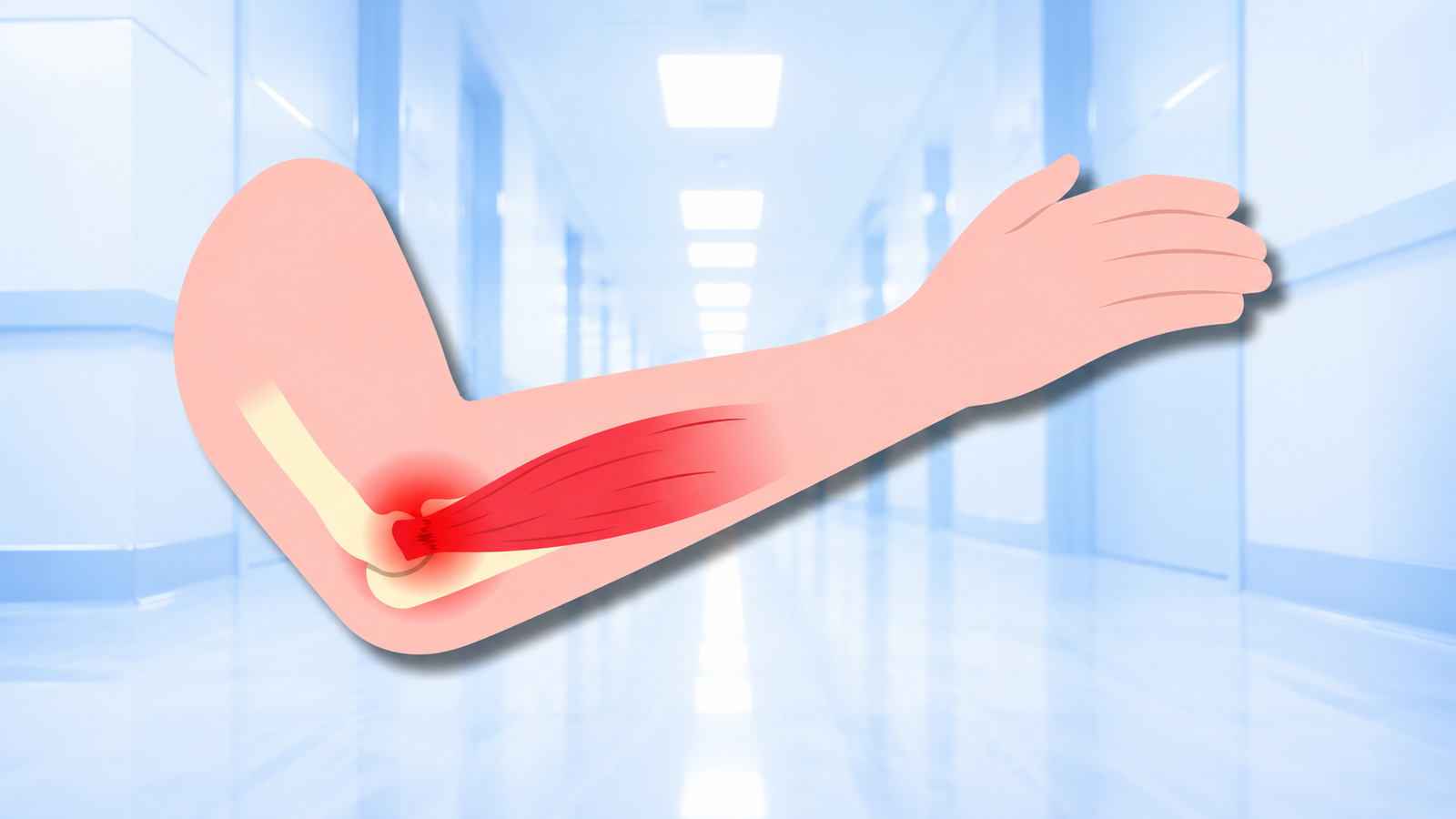 Tendonitis Elbow: Causes, Symptoms and How to Heal It Faster